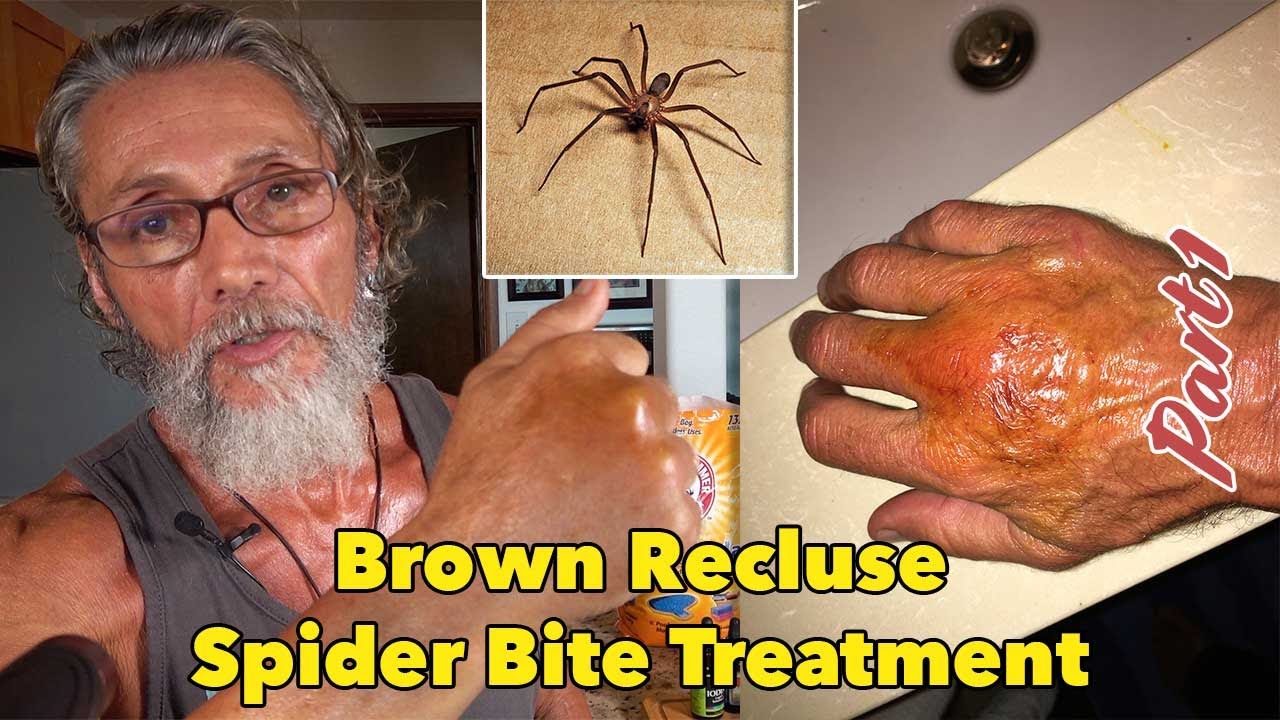 brown recluse spider bite